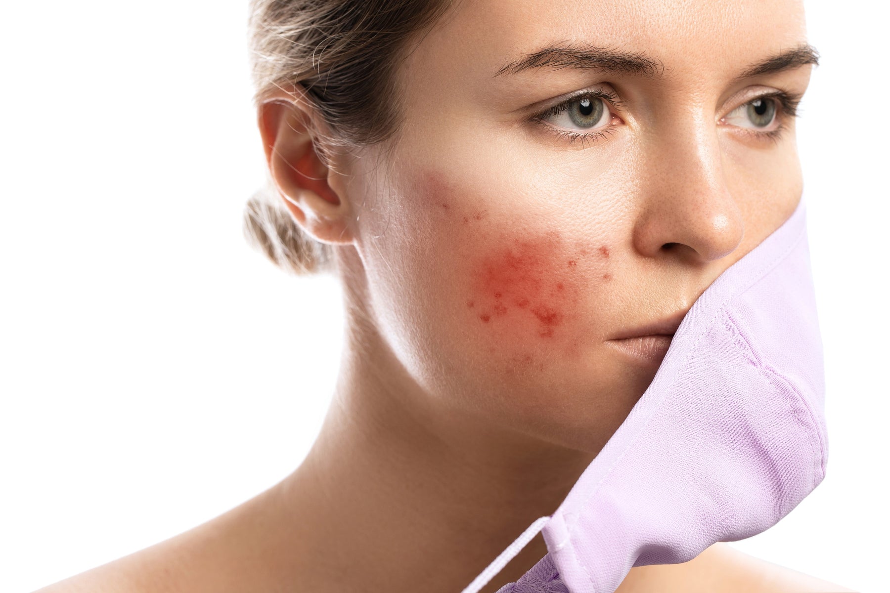 Tips for Preventing Acne