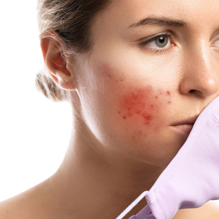 Tips for Preventing Acne